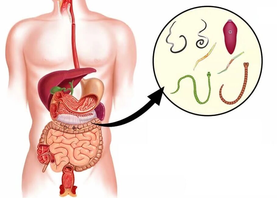 Vermixin aitab enamiku helmintitüüpide puhul