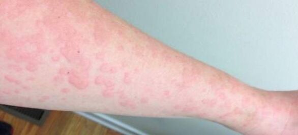 Nahaallergia on märk parasiitide olemasolust kehas